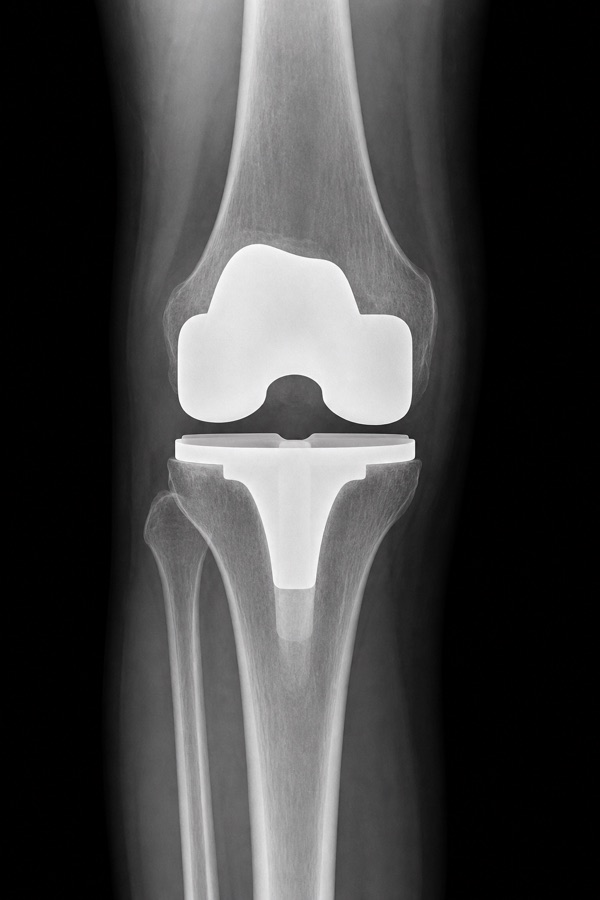 Radiografia de um joelho com prótese